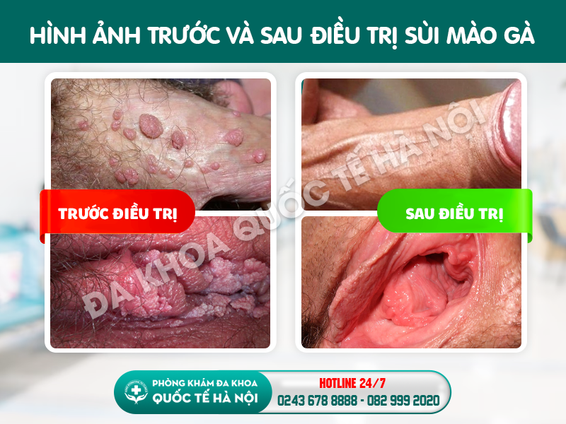 hình ảnh trước sau điều trị sùi